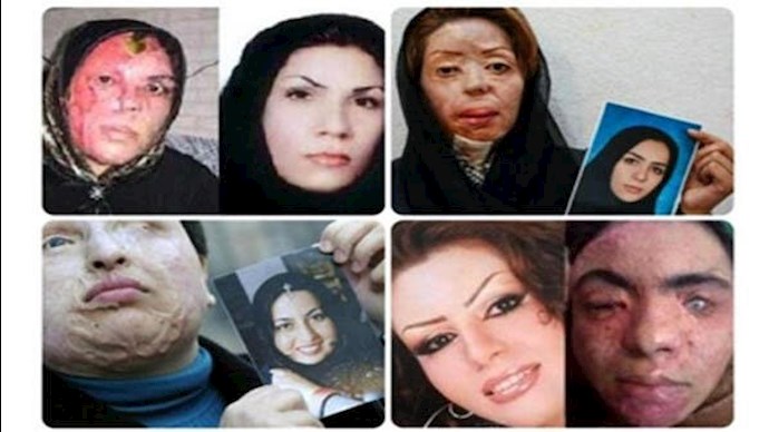 Iranian women victims of acid attacks by basij forces